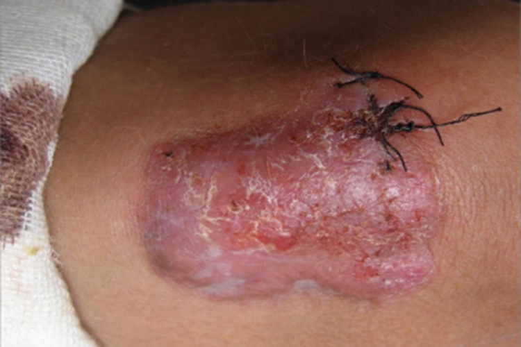 增殖性皮炎膝盖红斑图 增殖性皮炎膝盖红斑图