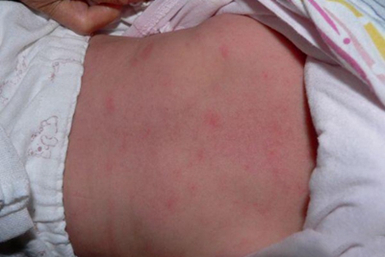 新生儿毒性红斑症状图