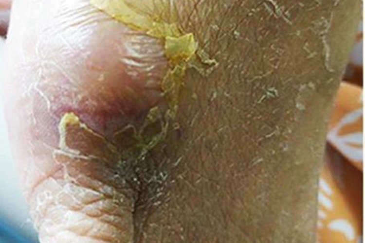 播散性镰刀菌病脱皮图 播散性镰刀菌病脱皮图