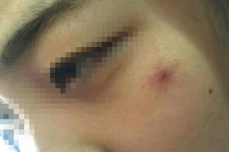 面部红痣图 面部红痣图