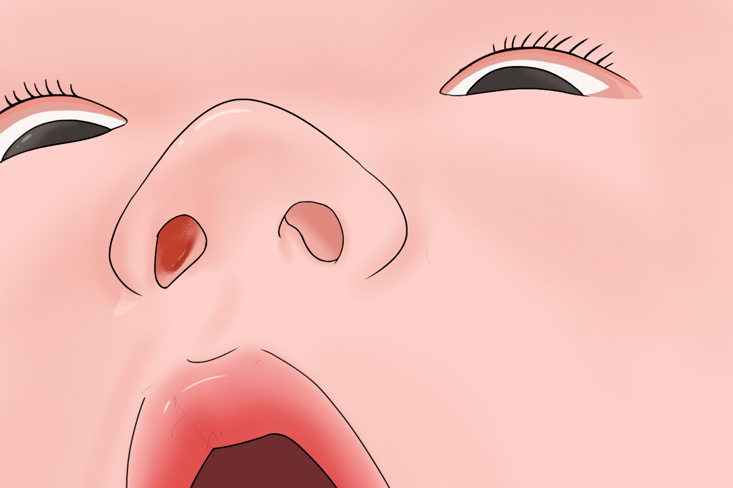 新生儿鼻腔血管瘤图