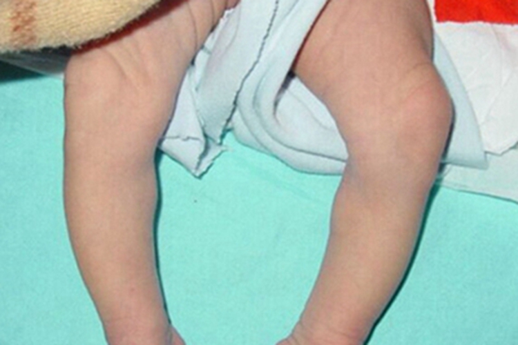 维生素D依赖性佝偻病症状图 维生素D依赖性佝偻病症状图