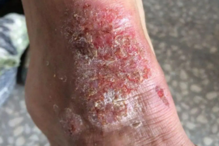 慢性湿疹溃疡图 慢性湿疹溃疡图