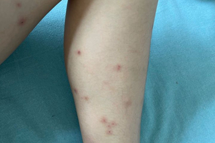 跳蚤叮咬小腿红点图