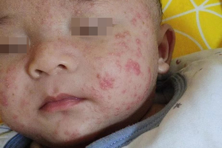 新生儿痤疮图