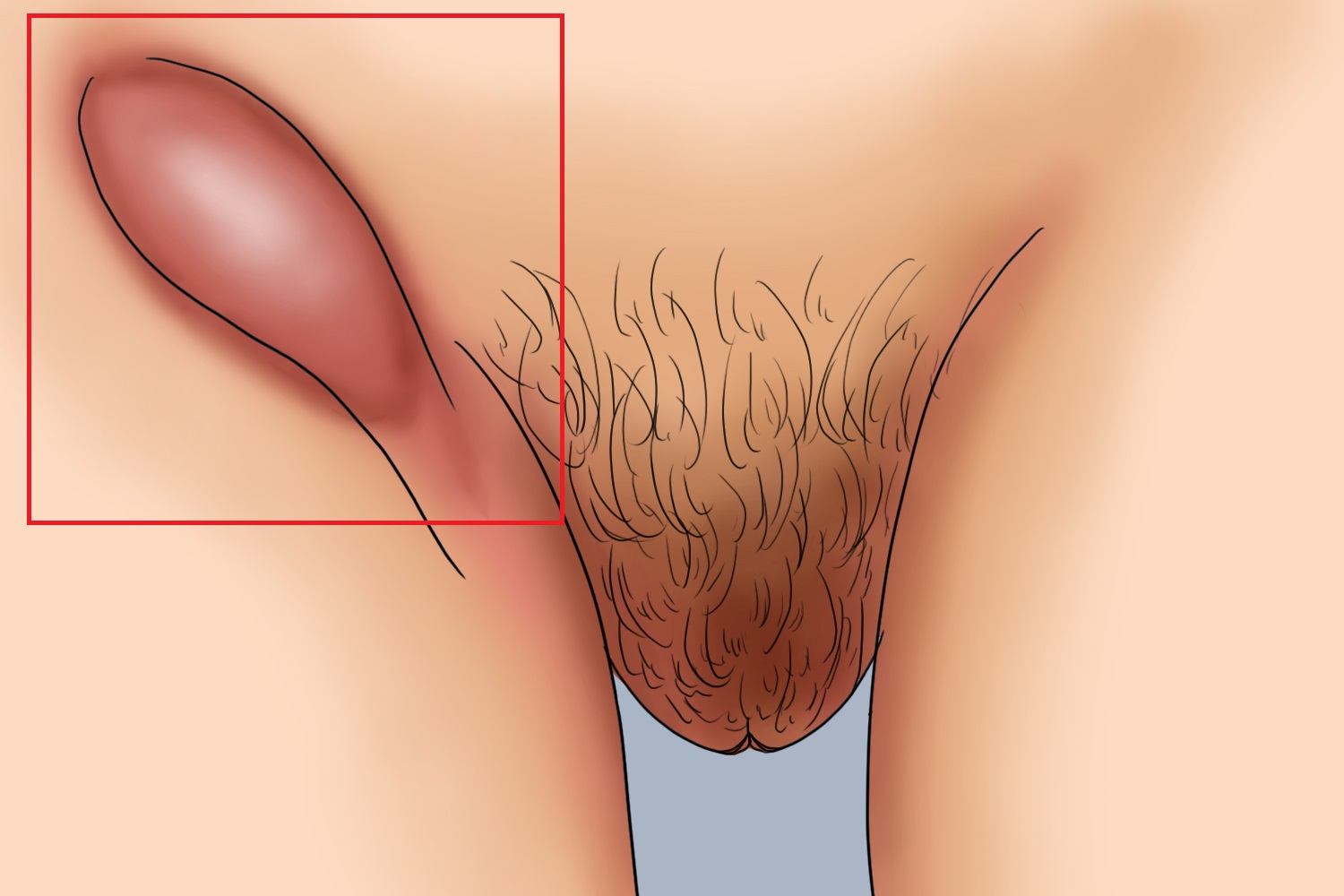 中期性病性淋巴肉芽肿症状图
