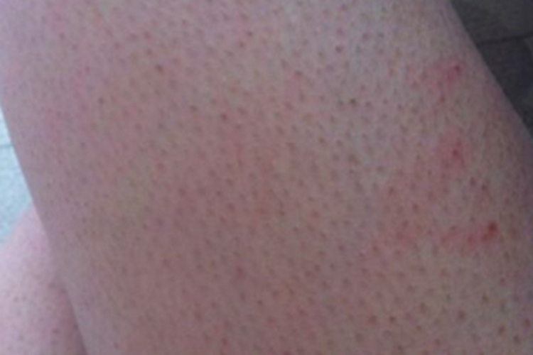 毛囊性鱼鳞病大腿红褐色疹子图