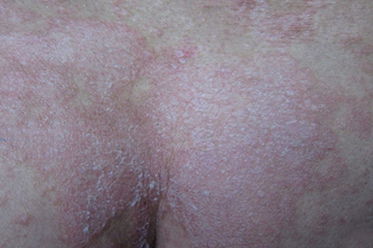 副银屑病臀部红斑图
