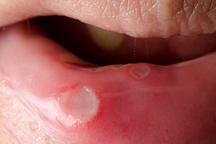 轻型口疮下唇溃疡图