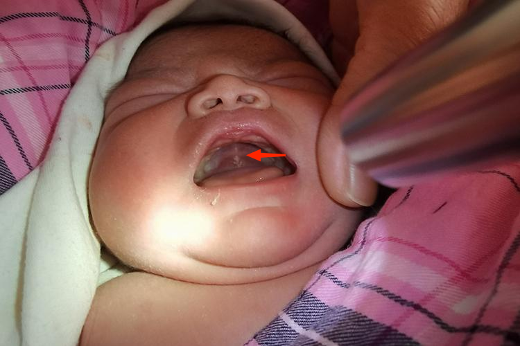 上腭中线附近处的马牙图 上腭中线附近处的马牙图