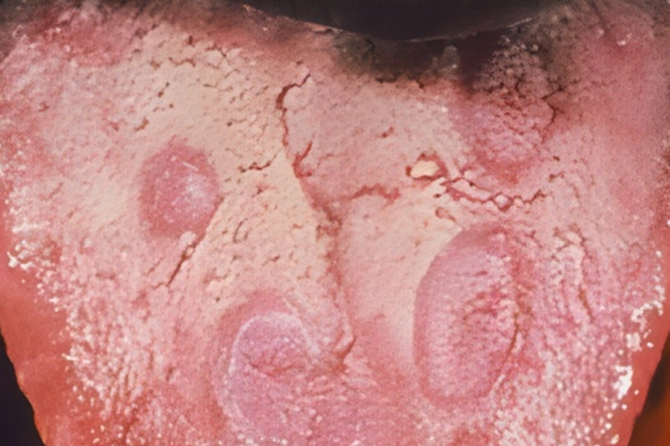 三期梅毒口腔舌炎图