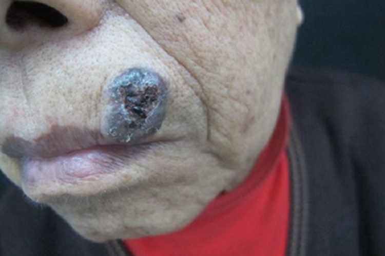 结节型基底细胞瘤口周大疙瘩图