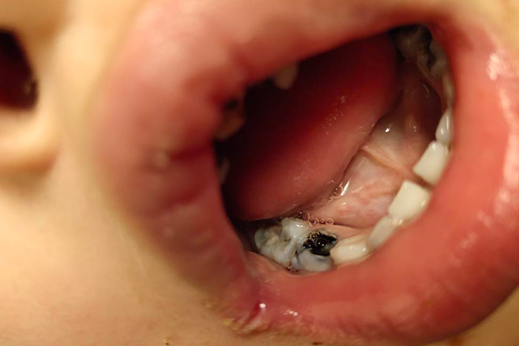 小孩牙齿长虫子图