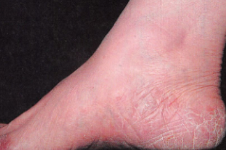 足癣鳞屑角化型图