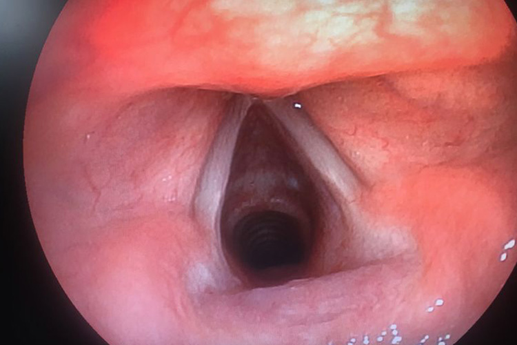 小孩喉镜下喉咙发炎图