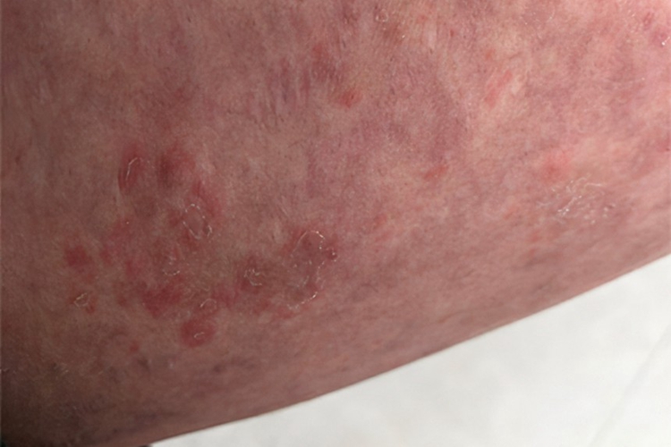 大腿内侧湿疹图 大腿内侧湿疹图