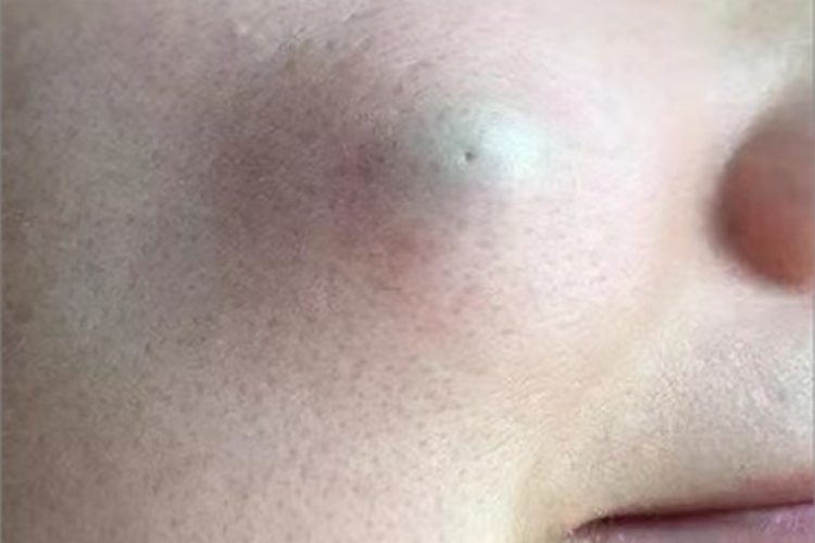 表皮囊肿面部大包图