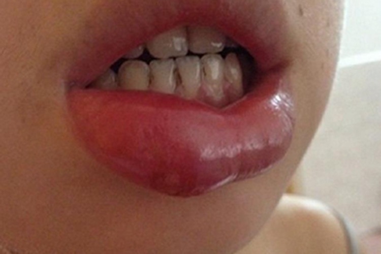 获得性血管性水肿嘴唇症状图 获得性血管性水肿嘴唇症状图