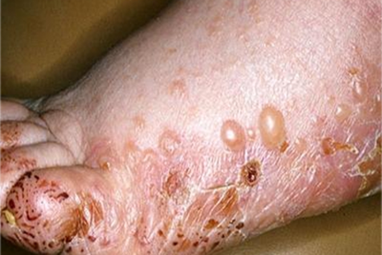 家族性良性慢性天疱疮脚部水疱图