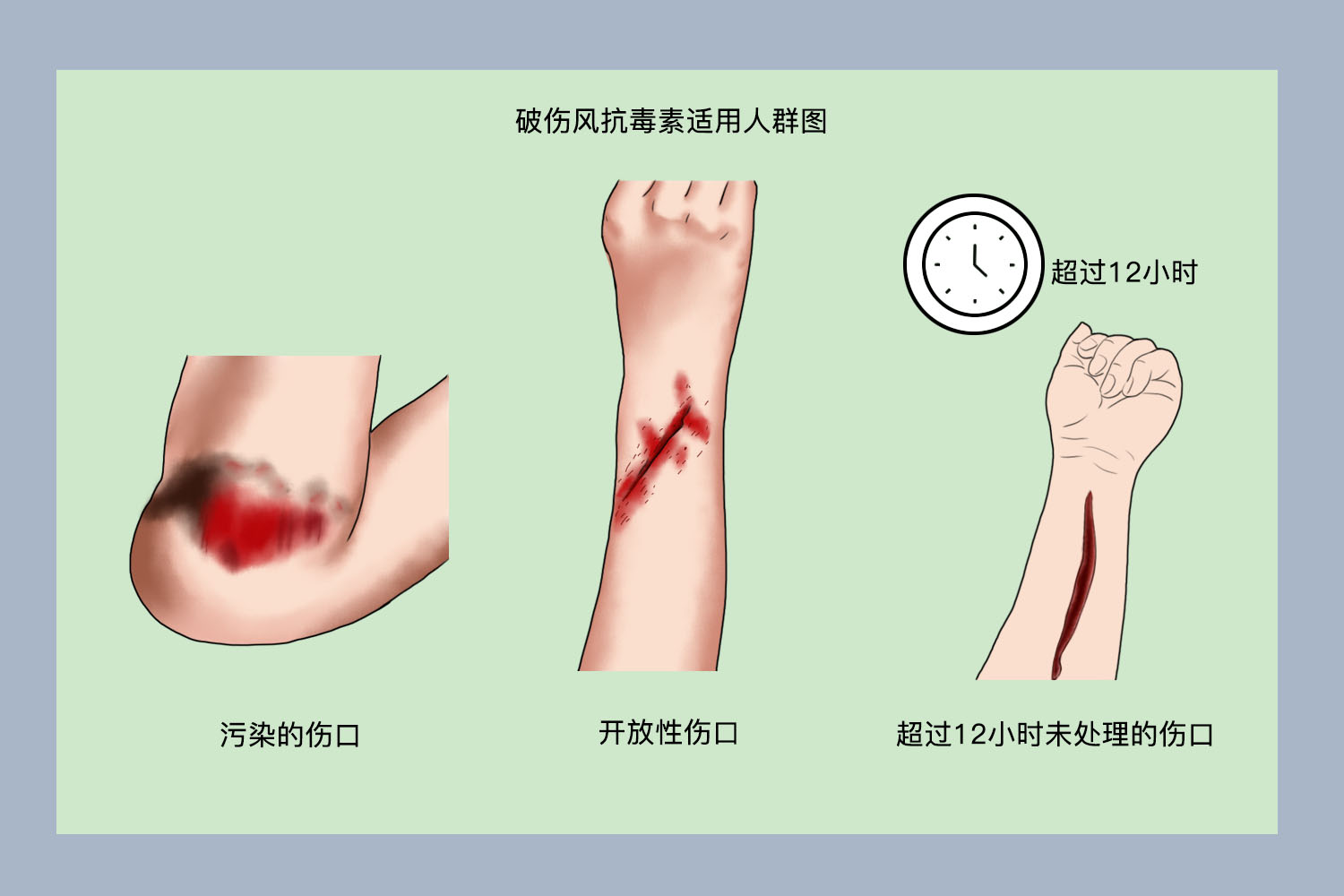 破伤风抗毒素适用人群图