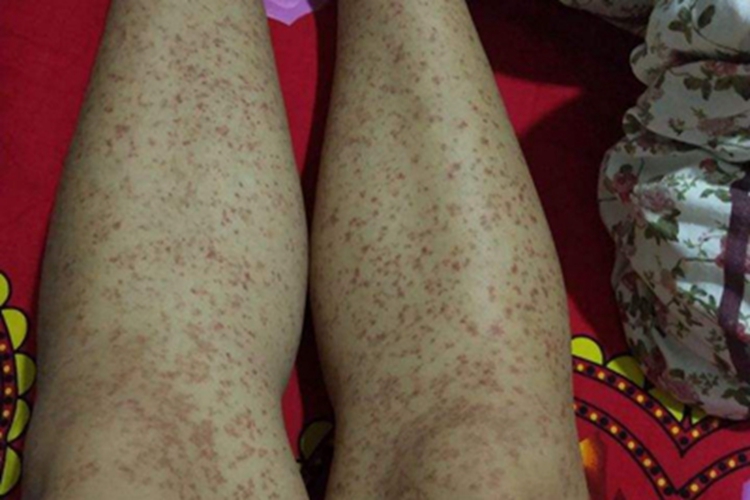 过敏性紫癜小腿紫斑图