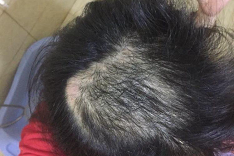 拔毛癖头顶头发稀少图