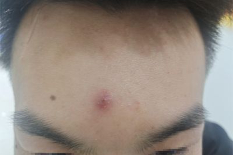 疖前额有红色疙瘩图 疖前额有红色疙瘩图