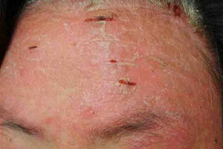 红皮病脱屑期前额脱屑裂口图