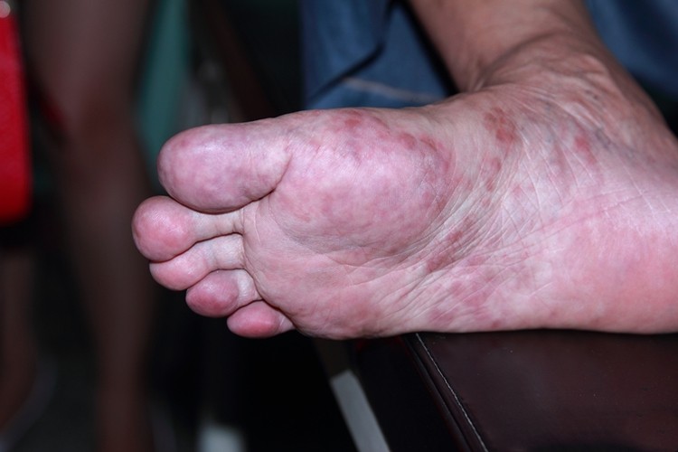 毛发红糠疹性红皮病脚底红斑图 毛发红糠疹性红皮病脚底红斑图