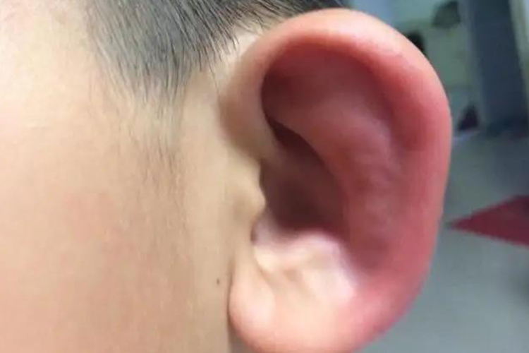 耳廓化脓性软骨膜炎红肿图 耳廓化脓性软骨膜炎红肿图