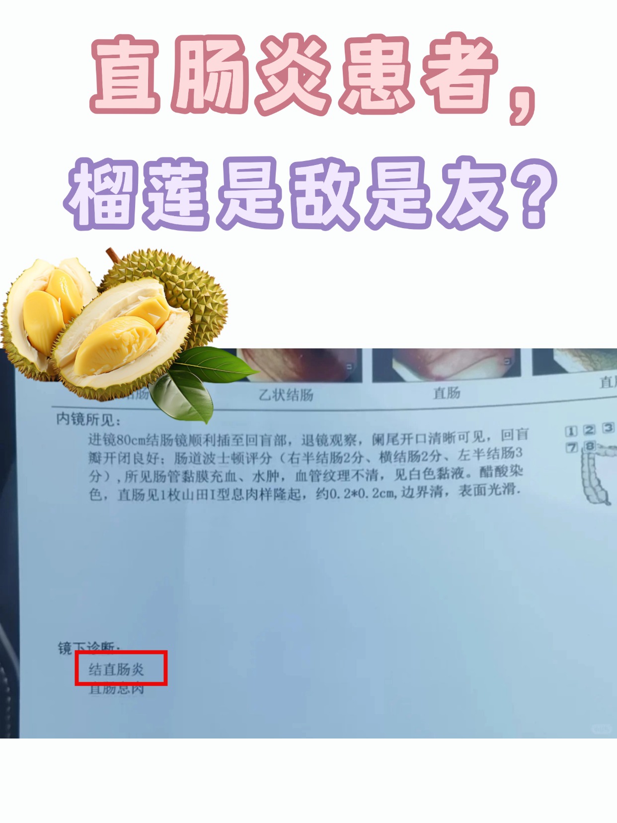 直肠炎患者,榴莲是敌是友?