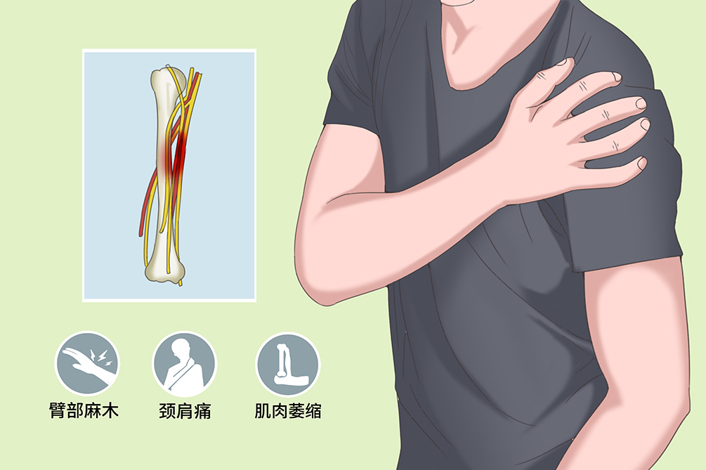 臂神经痛 位置图片