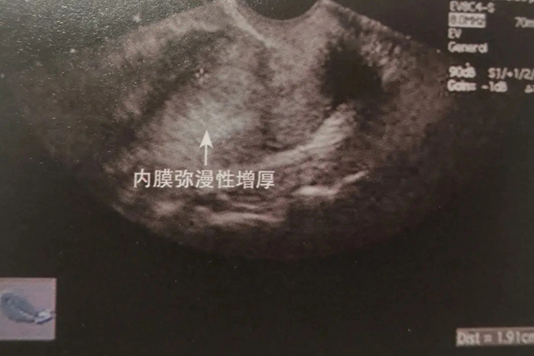 子宫内膜增厚图 子宫内膜增厚图