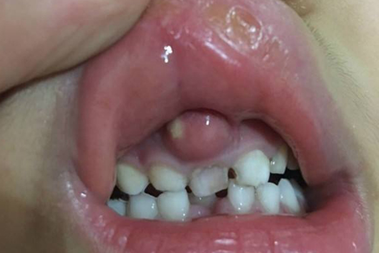 上牙龈急性牙周脓肿图 上牙龈急性牙周脓肿图