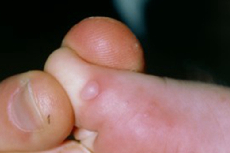 手足口病脚趾小水疱图 手足口病脚趾小水疱图