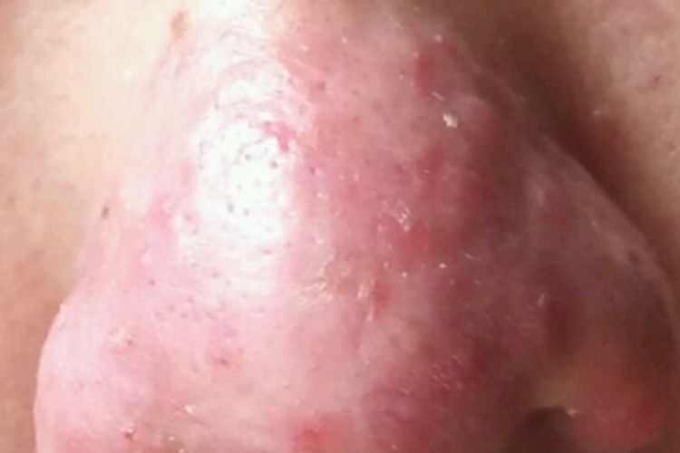 丘疹脓疱型酒糟鼻鼻尖红肿图