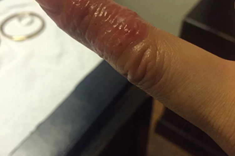 皮肤过敏红肿手部水疱图 皮肤过敏红肿手部水疱图