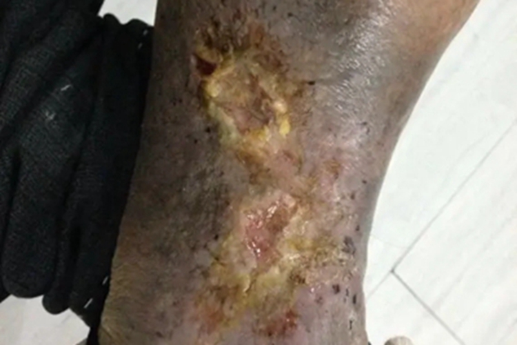 静脉曲张性溃疡小腿化脓图 静脉曲张性溃疡小腿化脓图