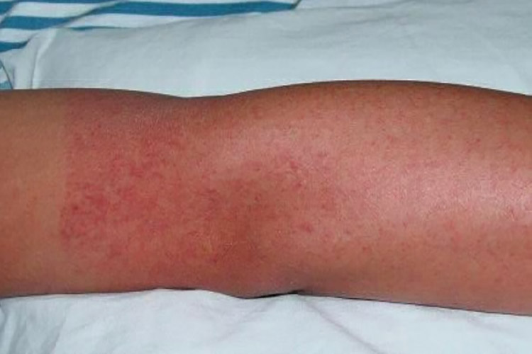 登革热皮疹图