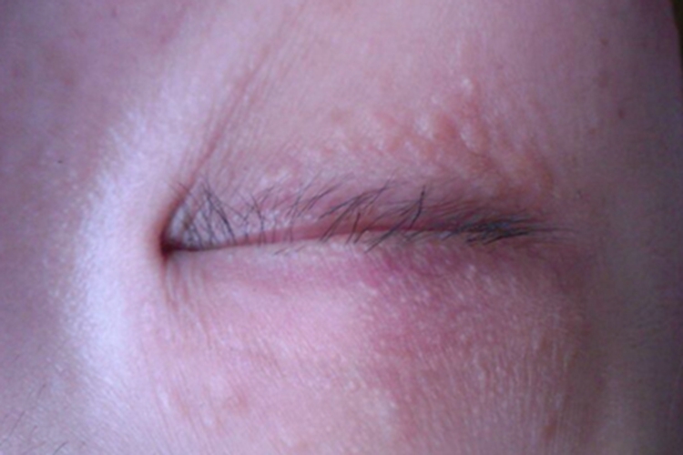 汗腺瘤眼周一圈疙瘩图
