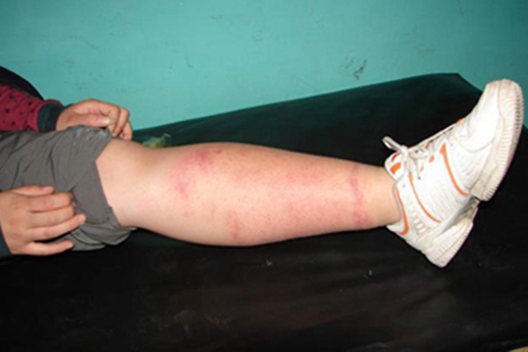 丹毒小腿红肿图