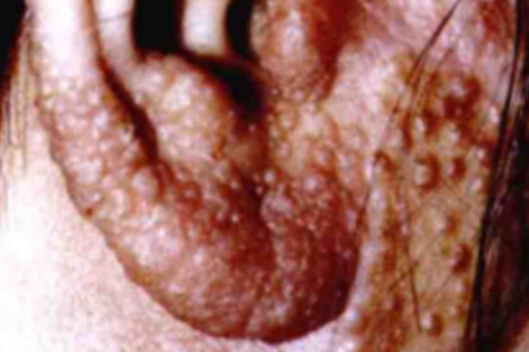 无绿藻病耳部丘疹图