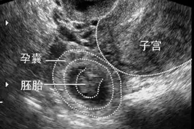 输卵管妊娠超声图