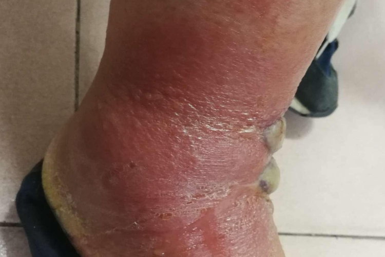 脚踝接触性皮炎图