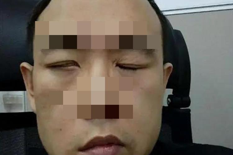 中枢性面神经麻痹图