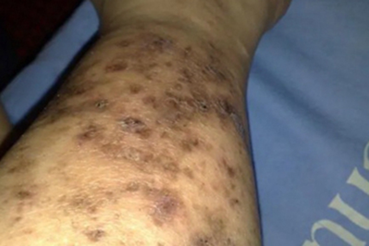 变应性血管炎小腿皮肤粗糙图