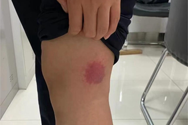蚊虫叮咬大腿有红斑图 蚊虫叮咬大腿有红斑图