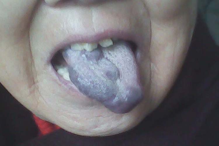 舌头海绵状血管瘤舌苔发蓝图