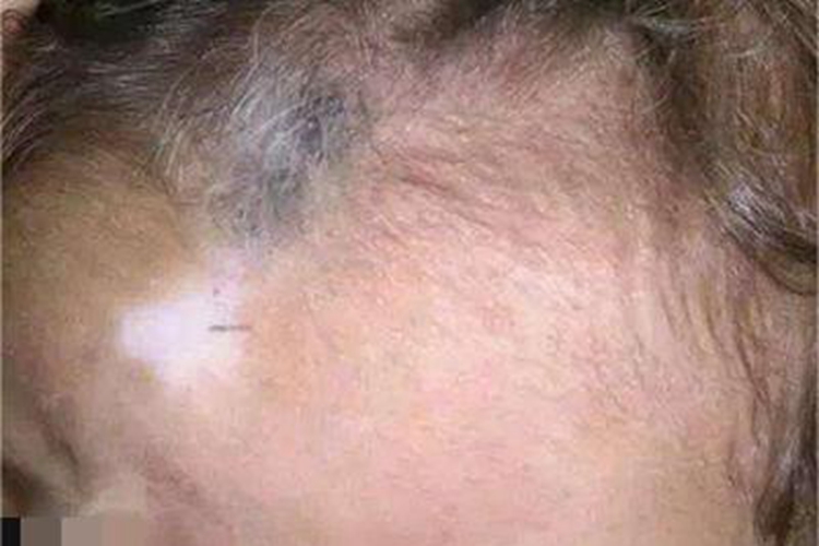 斑驳病前额上一块白斑图 斑驳病前额上一块白斑图