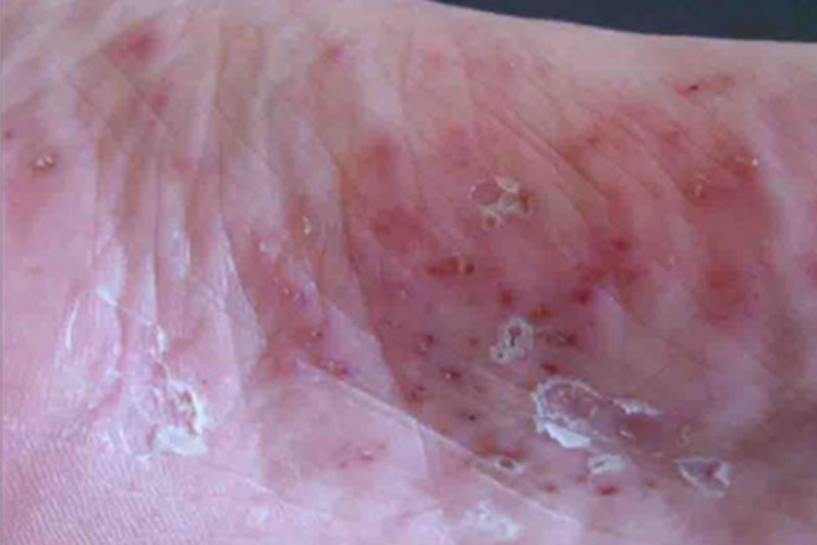 湿疹样型癣菌疹脚底脱皮图